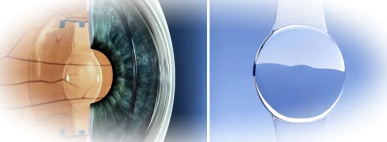 Замена рефракционной линзы - метод коррекции зрения