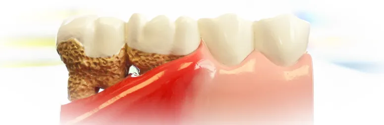 Пародонтит и пародонтоз - в чем разница?