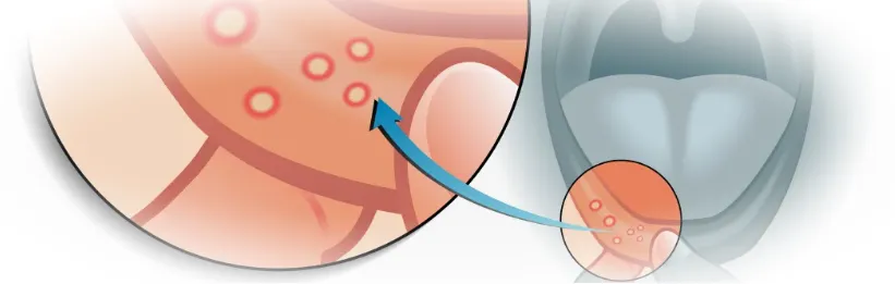 Особенности язвенного стоматита