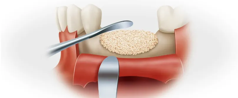 Костная пластика при имплантации зубов